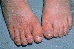swollen hands & feet combined w/itchy rash - Neurological ...