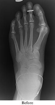 bunion before
