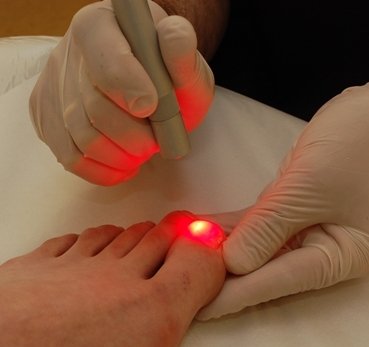 Fungal Toe Nail Infection : Laser Fungal Nail Treatment Los Angeles
