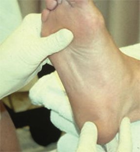 heel pain