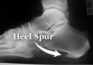 heel pain