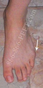 Moderate Tailor's Bunion