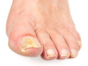 Athletes Foot