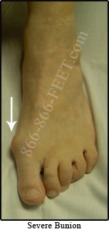 severe bunion