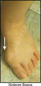 moderate bunion