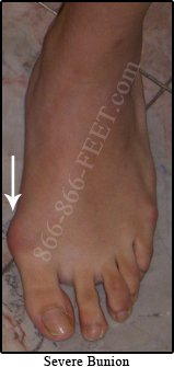 severe bunion