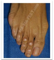 Cosmetic Foot Surgery