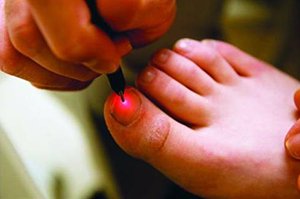 Laser on Big Toe