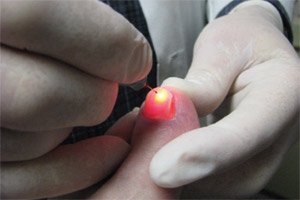 Laser on Big Toe