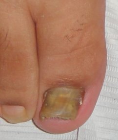 Big Toe with Nail Fungus