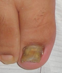 Big Toe with Nail Fungus