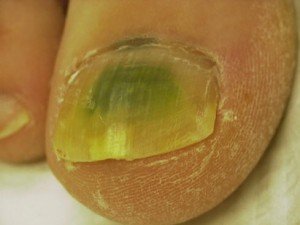 Big Toe Nail with Fungus