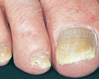 Toe Nails with Fungus