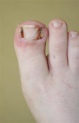 Ingrown Toenails