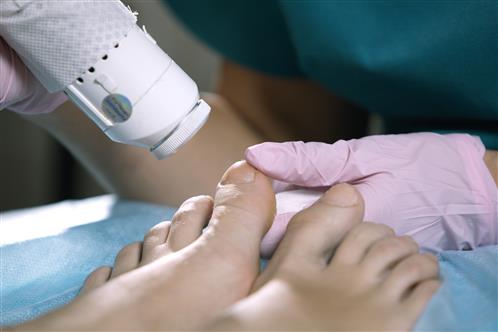 Laser Nail Treatments